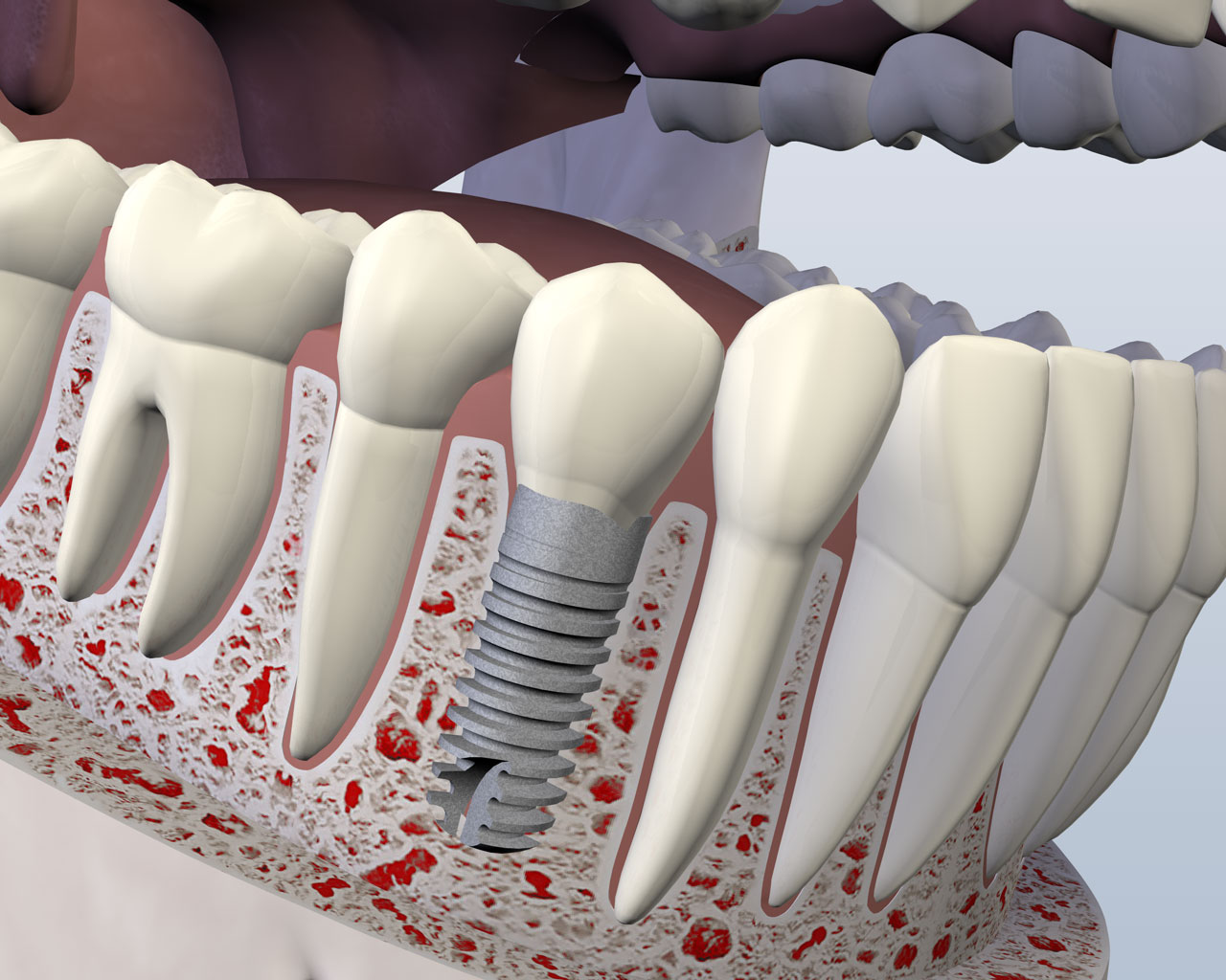 Oral Surgery Houston and Sugar Land Southwest Oral & Implant Surgery