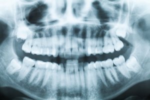 An x-ray of the teeth and jaws