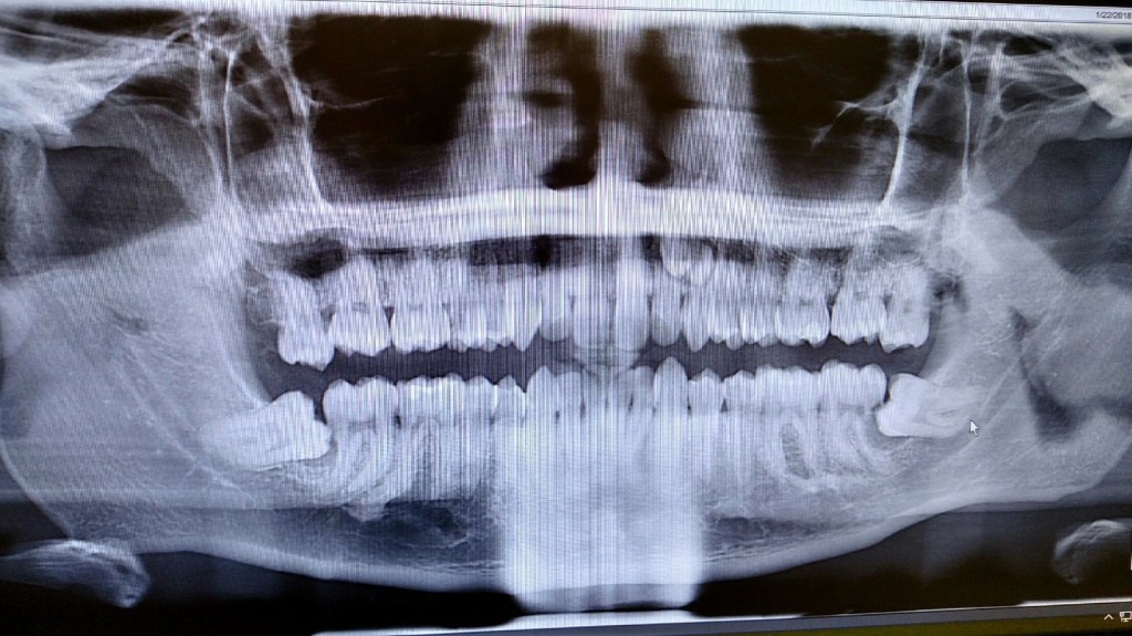 X-ray of teeth and jaws