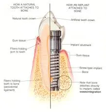 A diagram showing Dental Implant Surgery Procedure