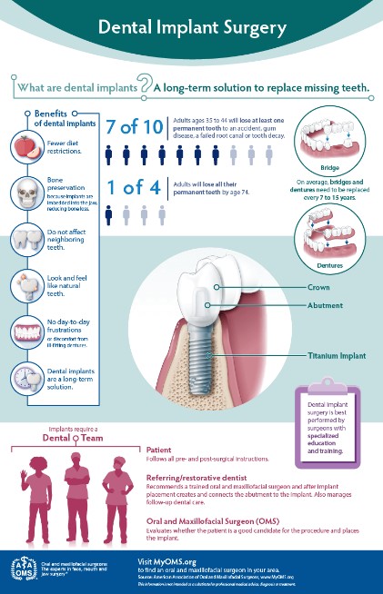 Dental Implant Infographic